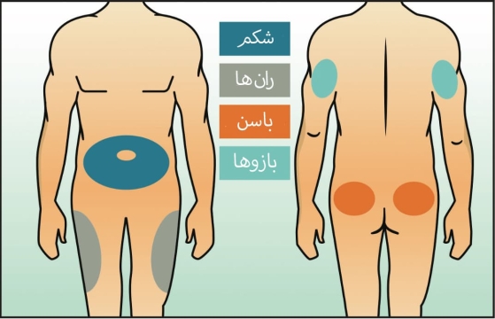 محل‌های تزریق انسولین | راهنمای عملی و کامل برای بیماران دیابتی